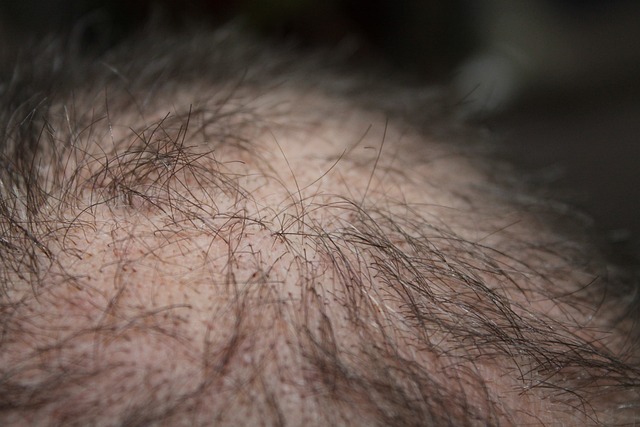 Erfahren Sie mehr über die Methoden und die Dauer der Behandlung von Alopezie